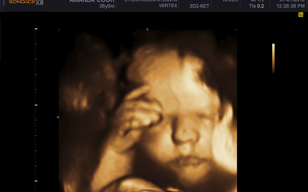 3D Ultrasound!